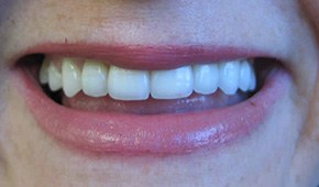Closeup of repaired smile after