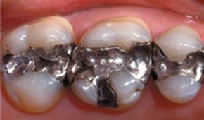 Tooth-colored dental restorations after treatment