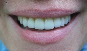 Closeup of woman's flawlessly aligned smile after