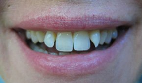 Closeup of woman's crooked smile before