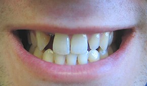 Closeup of flawless smile after treatment