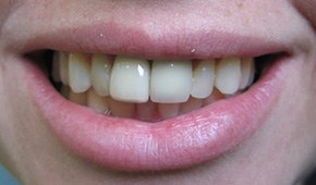 Closeup of dark colored front tooth before