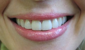 Closeup of white teeth after
