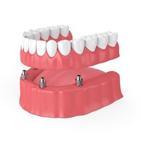 Digital illustration of implant dentures in Winthrop 