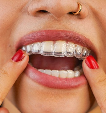 closeup of a woman putting Invisalign tray in her mouth