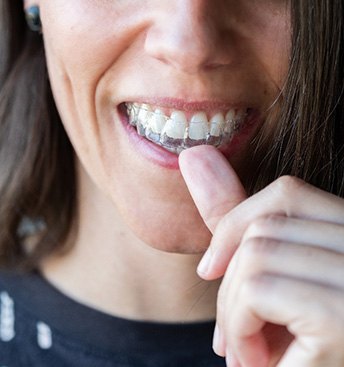 closeup of woman putting her top aligner in her mouth
