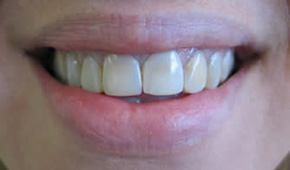 Closeup of discolored teeth before