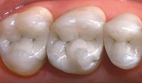 Tooth-colored dental restorations after treatment