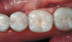 Four teeth with natural looking dental restorations after