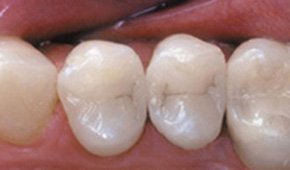 Three teeth with natural dental restorations after treatment