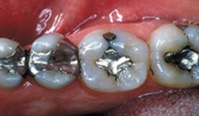 Four teeth with natural looking dental restorations after