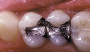 Three teeth with natural dental restorations after treatment