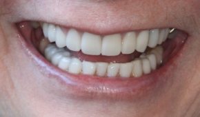 Smile after correcting slight darkening on the teeth
