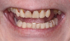 Smile with slight darkening on some teeth