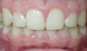 Smile after correcting slight darkening on the teeth