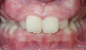 Smile with slight darkening on some teeth