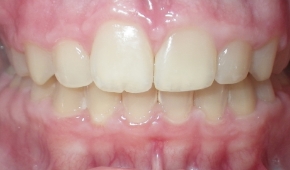 Smile after correcting slight darkening on the teeth
