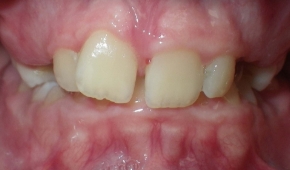 Smile with slight darkening on some teeth