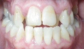 Smile with slight darkening on some teeth