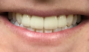 Smile after correcting slight darkening on the teeth