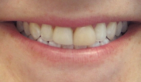 Smile with slight darkening on some teeth