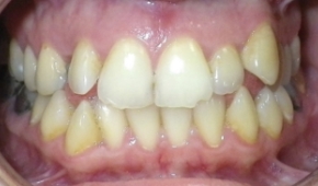 Smile with slight darkening on some teeth