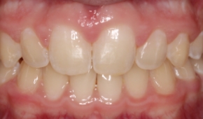 Smile after correcting slight darkening on the teeth