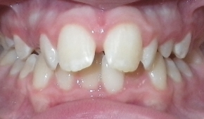Smile with slight darkening on some teeth