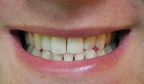 Closeup of smile with damaged front tooth before