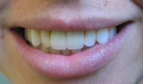 Closeup of bright white front tooth after