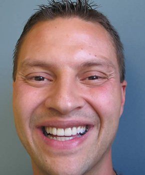 Man with flawlessly repaired front tooth after