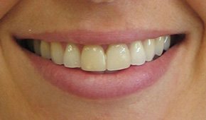 Closeup of yellowed teeth before