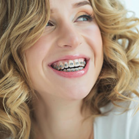 Woman with bracket and wire braces