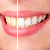 Teeth before and after whitening