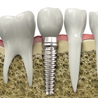 dental implant in jawbone