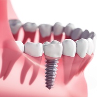 single unit implant