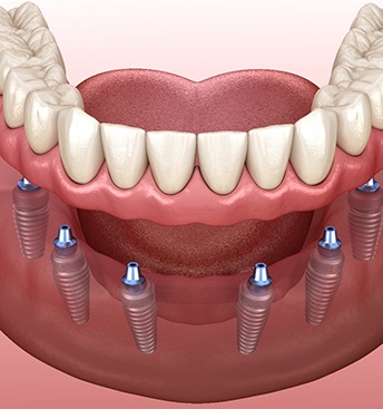 illustration of implant dentures 