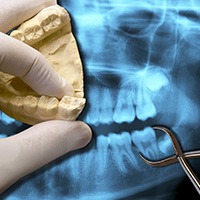 Smile model and x-ray of tooth to be removed