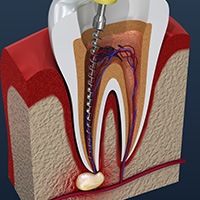Animation of root canal treatment process