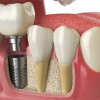 Digital illustration of dental implants in Winthrop 