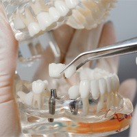 Winthrop implant dentist holding model jaw, implant, and restoration 