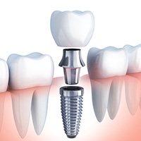 Animation of implant-retained dental crown placement