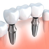 Animation of implant supported fixed bridge