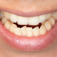close up of a person’s crowded teeth