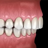 diagram of an overbite