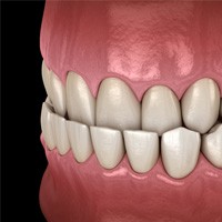 diagram of an underbite 