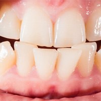crowded teeth for Invisalign in Winthrop 