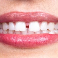 gaps between teeth needing Invisalign in Winthrop 