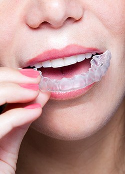 Closeup of patient placing Invisalign tray