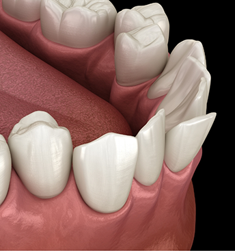 Illustration of a mouth with misaligned lower teeth